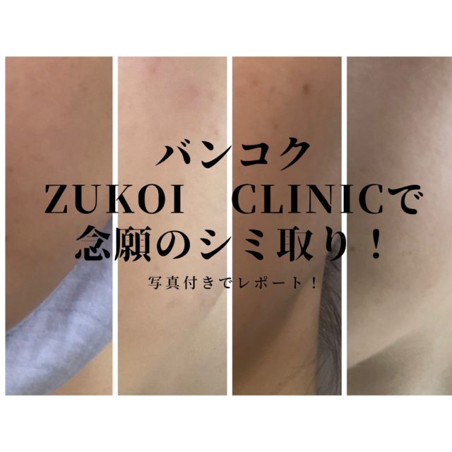 Zukoi Clinic バンコクでシミ取り全3回レポート 写真あり 働く駐妻 In バンコク